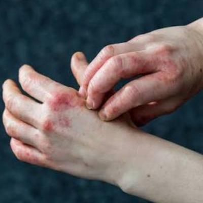 از اگزما دست و نحوه درمان آن چه می‌دانید؟