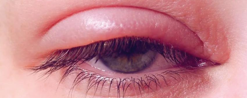 مهمترین عوارضی که کاشت مژه ممکن است برای چشم داشته باشد